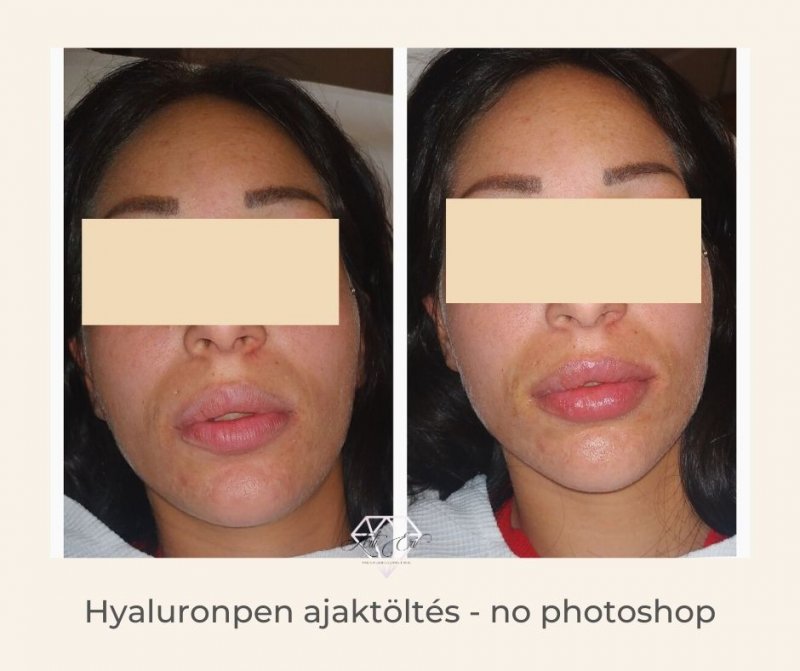 anti aging krémek otthoni jogorvoslati sejtterápia anti aging