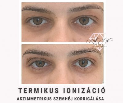 termikus-ionizacio-legjobb