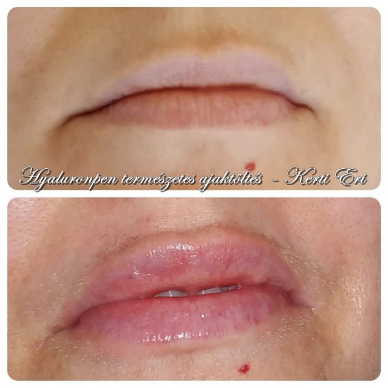 legjobb anti aging az ajkak számára