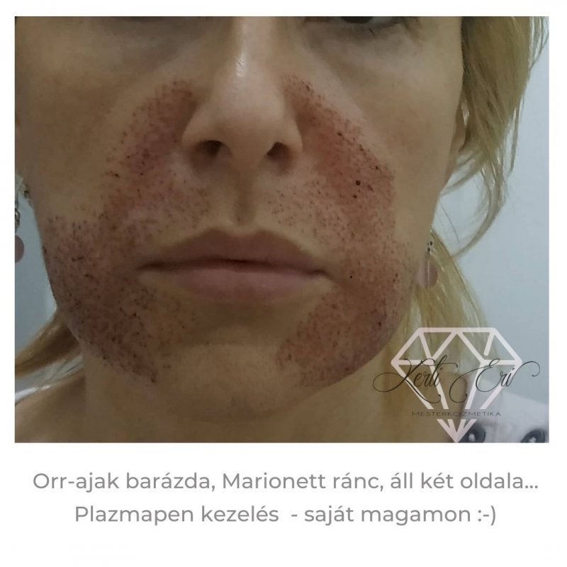 vérlemezkékben gazdag plazma anti aging kezelés