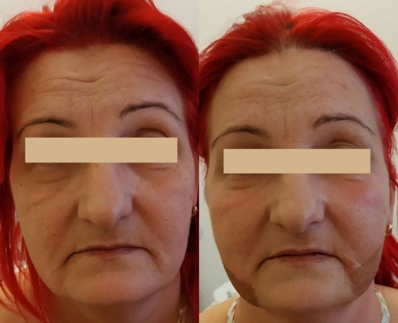 plazma anti aging kezelés)