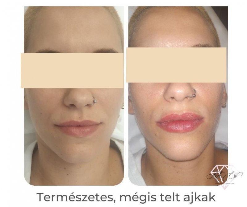 hyaluronsavas ráncfeltöltés gyöngyös